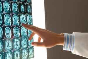 Causes of Brain Injuries